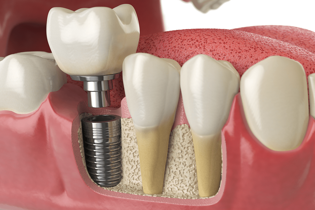 Ansicht eines implantatgestützen Zahnersatzes