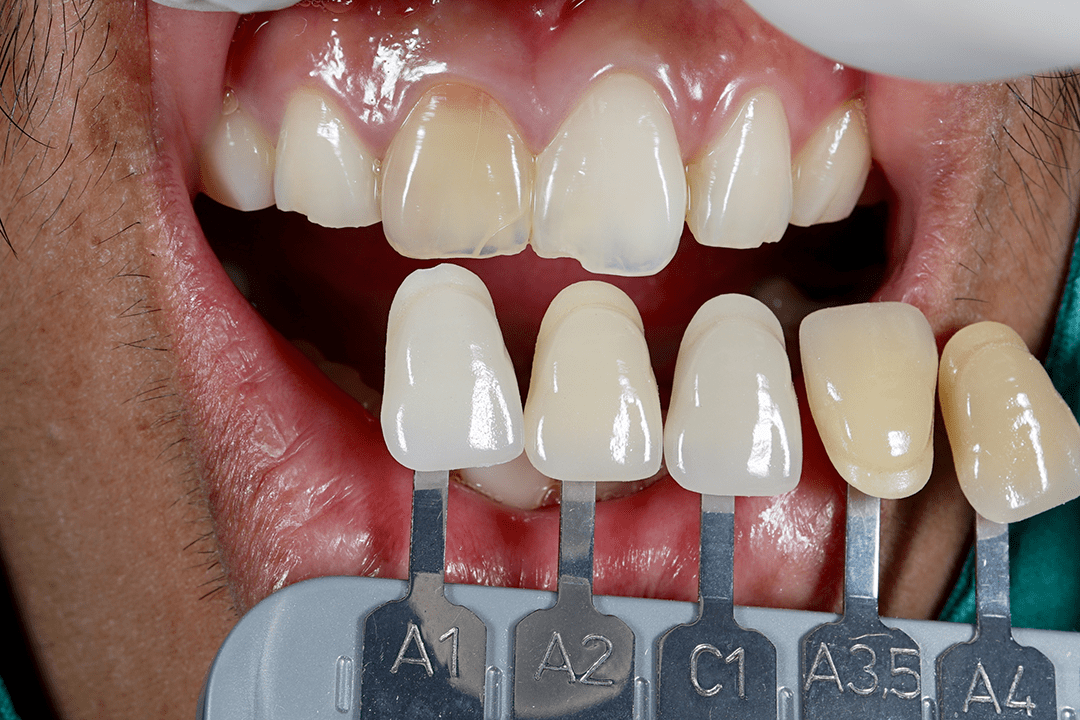 Zahnfarbbestimmung mit Vita Zahnschlüssel