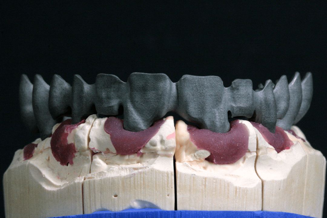 CAD SLM Brückengerüst mit Zahnfleischmaske