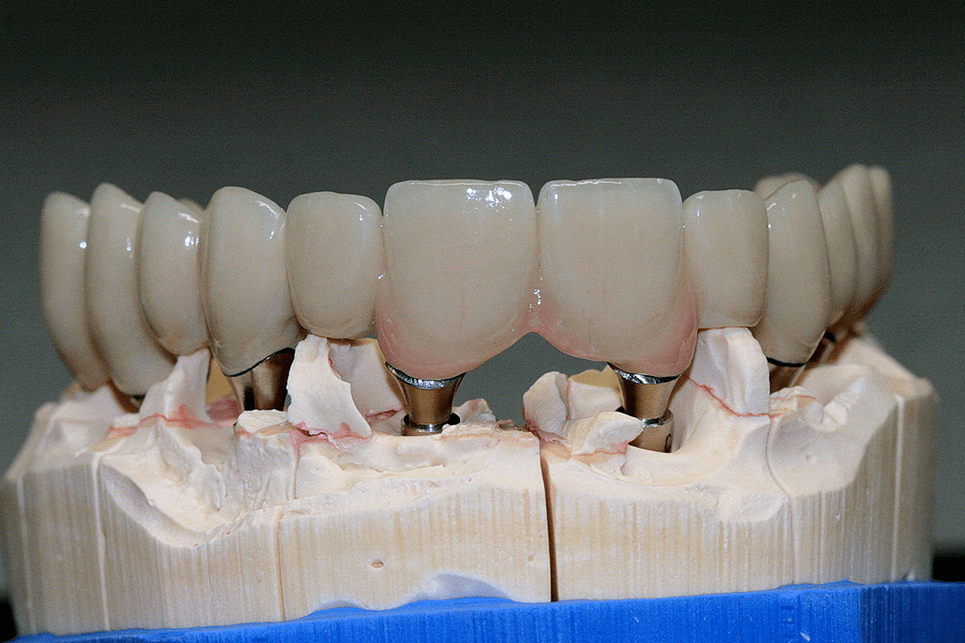 Fertiggestellte Implantatbrücke mit Keramik verblendet
