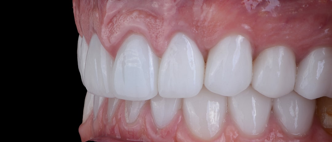 Fertiggestellte Implantatbrücken im Mund