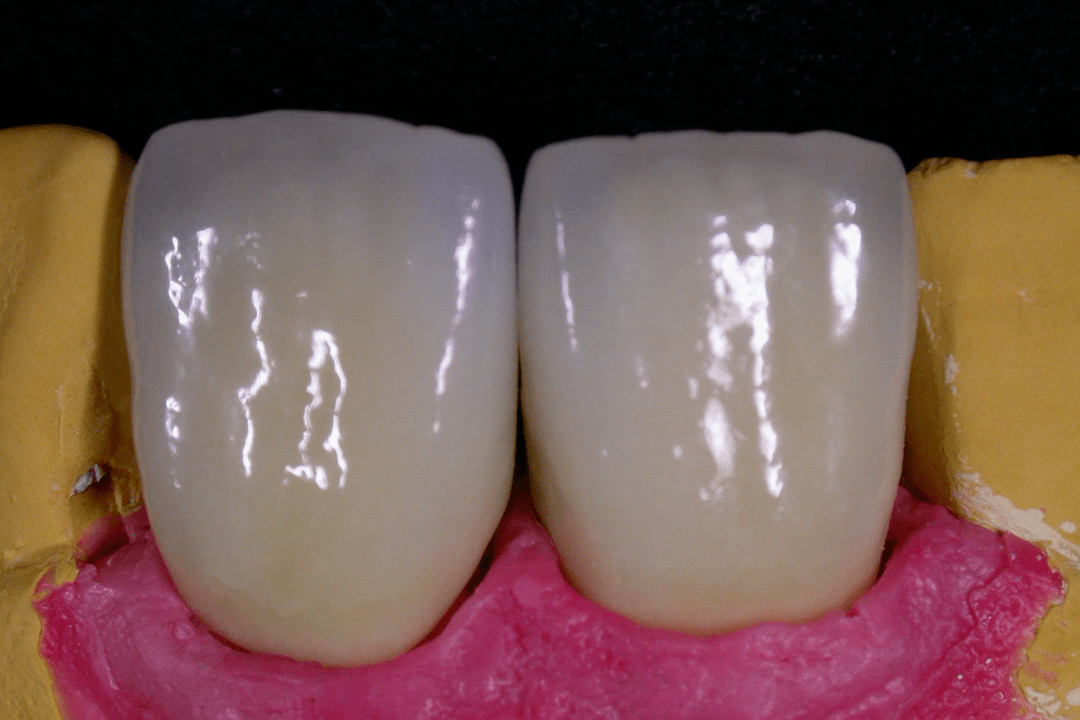 Zirkonkronen am Modell mit Zahnfleischmaske