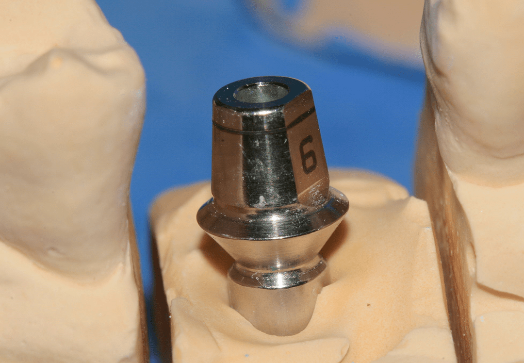 Ausgangssituation einer Implantatkrone