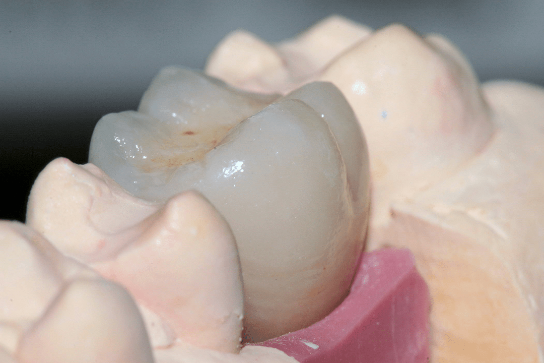 Implantatkrone am Modell mit Zahnfleischmaske